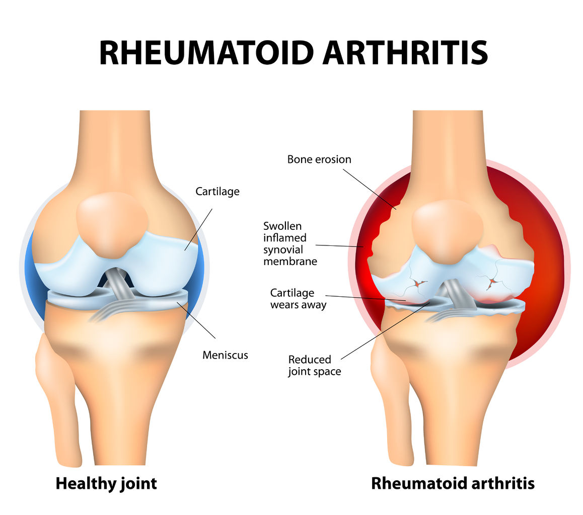 Rheumatoid arthritis NJ specialist